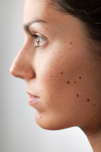 Portrait of a Woman with Melanoma Moles and Freckles. Selective focus on the cheek. Nikon D3X. Converted from RAW (XXXL)