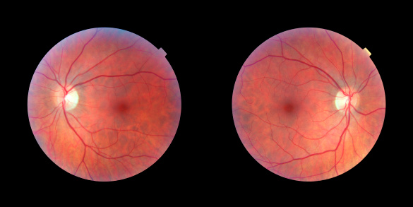 Pair of human retinas - left and right eye, same person