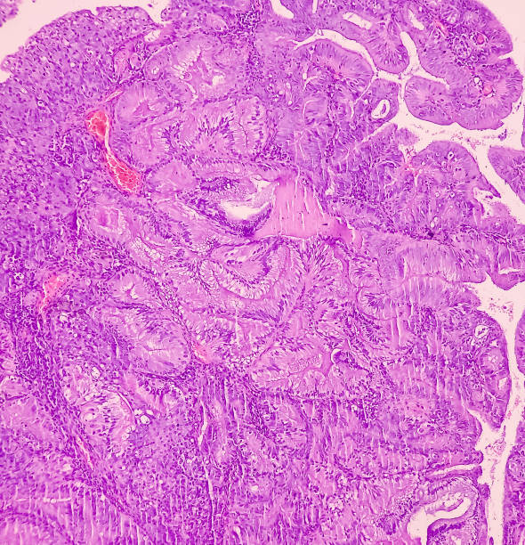 adenocarcinoma de endométrio. câncer de útero. carcinoma seroso papilífero uterino (ctup). mostrar tecido endometrial de serosa papilar do tipo (g-2). - endometrial adenocarcinoma - fotografias e filmes do acervo