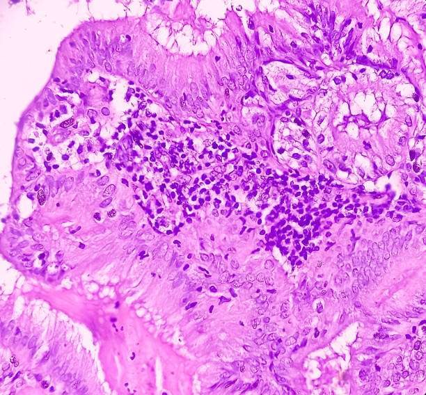 adenocarcinoma de endométrio. câncer de útero. carcinoma seroso papilífero uterino (ctup). mostrar tecido endometrial de serosa papilar do tipo (g-2). - endometrial adenocarcinoma - fotografias e filmes do acervo