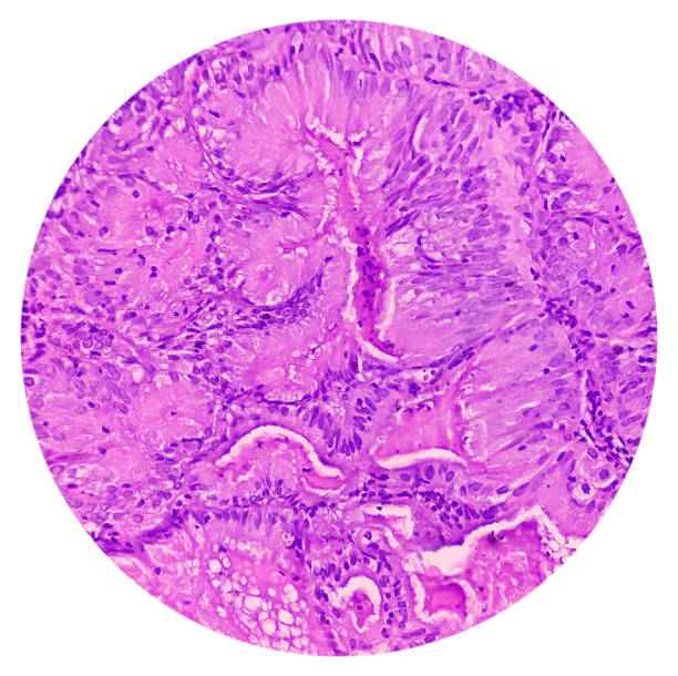 adenocarcinoma de endométrio. câncer de útero. carcinoma seroso papilífero uterino (ctup). mostrar tecido endometrial de serosa papilar do tipo (g-2). - endometrial adenocarcinoma - fotografias e filmes do acervo