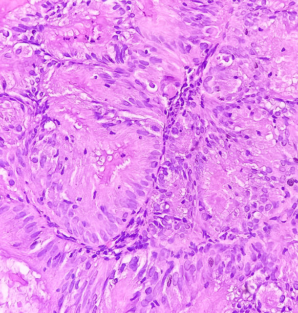adenocarcinoma de endométrio. câncer de útero. carcinoma seroso papilífero uterino (ctup). mostrar tecido endometrial de serosa papilar do tipo (g-2). - endometrial adenocarcinoma - fotografias e filmes do acervo