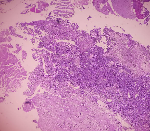 rak nerki: obraz mikroskopowy przerzutowego raka jasnokomórkowego nerki, najczęstszego typu raka nerkowokomórkowego. pokaż tkankę mózgową nowotworu złośliwego, duże atypowe dziwaczne komórki. - kidney cancer zdjęcia i obrazy z banku zdjęć