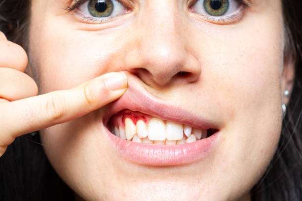 Bleeding gums. Macro of a woman's mouth with red gums. Inflammation caused by gingivitis Closeup of a girl with bleeding gums lifting her lip with her finger. Macro of a woman's mouth with red gums. Inflammation caused by gingivitis pain points stock pictures, royalty-free photos & images