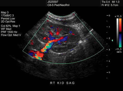 Ultrasound of Kidney  or KUB  for  screening  renal stone disease or Urolithiasis.