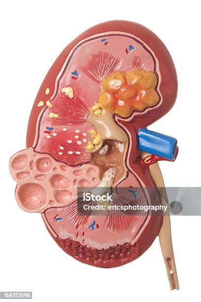 Deseased Kidney Auf Weißem Hintergrund Stockfoto und mehr Bilder von Nierenstein - Nierenstein, Modell, Anatomie