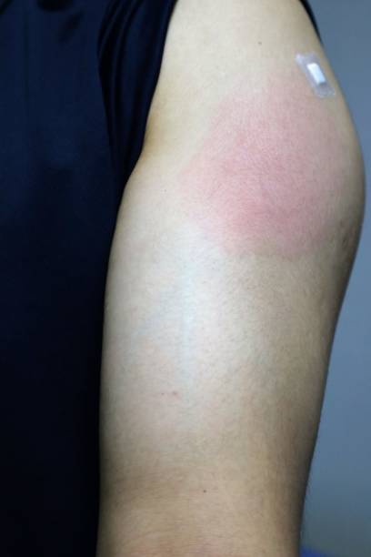istock Side effects after corona vaccine vaccination 1683322032