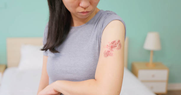 Painful shingles in woman Woman with shingles on the skin she feels very painful shingles rash stock pictures, royalty-free photos & images