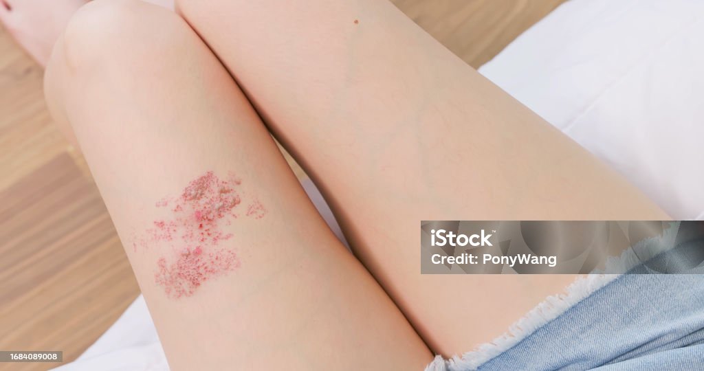 Painful shingles in woman Woman with shingles on the skin she feels very painful Color Image Stock Photo