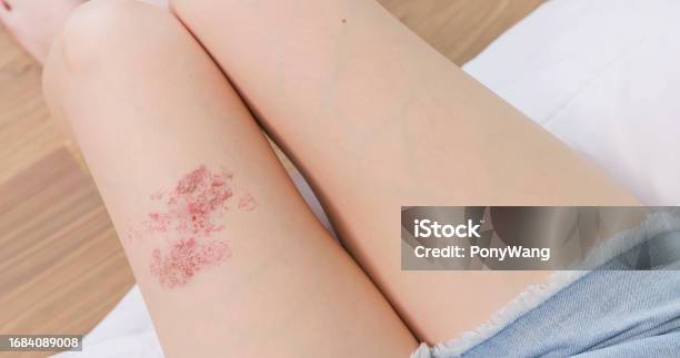 Painful Shingles In Woman Stock Photo - Download Image Now - Color Image, One Woman Only, Red
