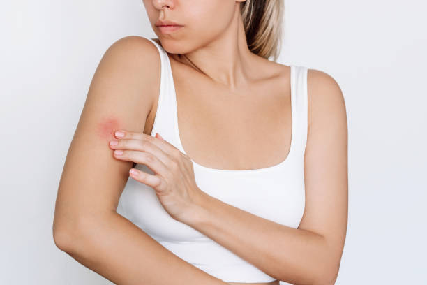 giovane donna preoccupata che tocca una puntura d'insetto sul suo braccio. un'eruzione cutanea rossa causata da allergia - horse fly foto e immagini stock