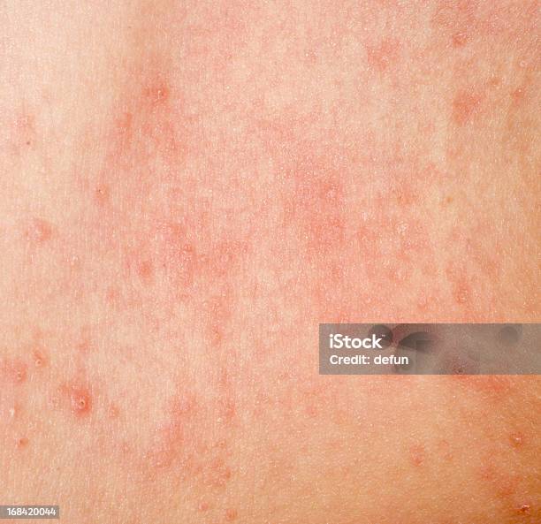 Foto de Alérgicos Extravagantes Dermatite Textura Da Pele e mais fotos de stock de Alergia - Alergia, Ciência, Condição