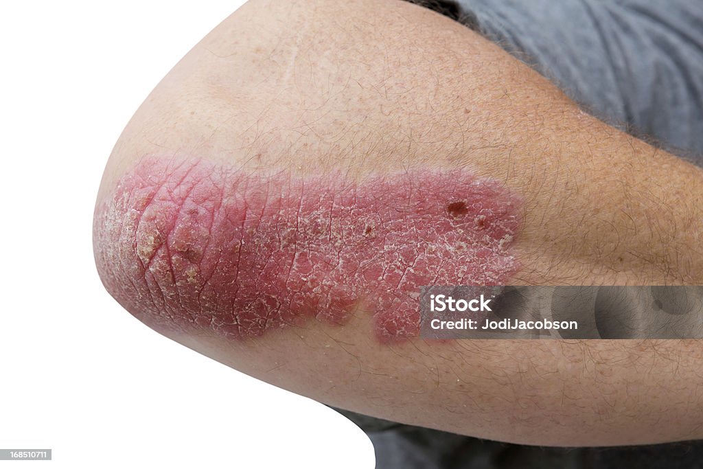 psoriasis on a mid age mans  elbow psoriasis on a mid age mans elbow. Not isolated.  Psoriasis Stock Photo