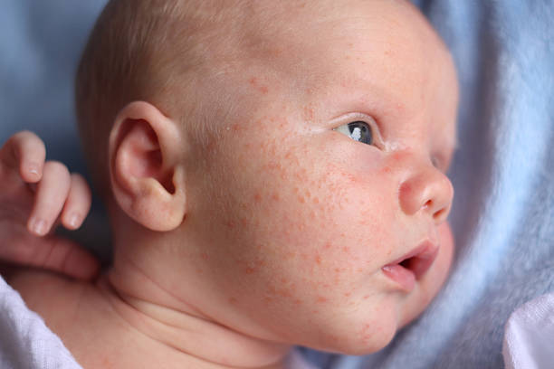 akne für neugeborene babys - akne stock-fotos und bilder