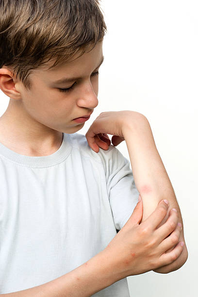 Boy looking at mosquito bite Boy looking at mosquito bite skin condition photos stock pictures, royalty-free photos & images