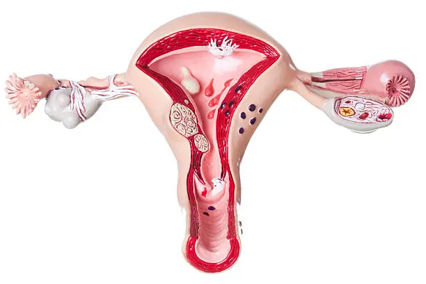 Anatomically correct model of Uterus and Ovaries with some most common pathologies, endometriosis, adhesions, fibroids, salpingitis, cysts, pedunculated fibroid tumor, polyps and various carcinoma. White background.