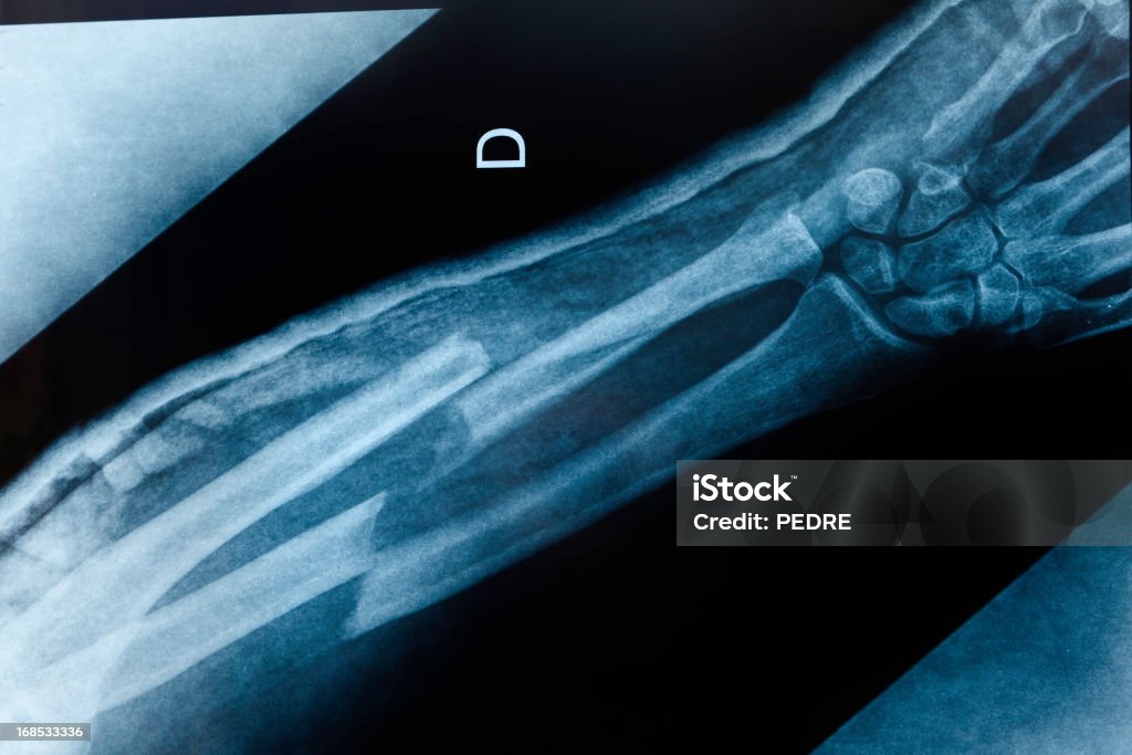 broken arm x-ray An x-ray image of an boken arm with double fracture: radius and ulna. Bone Fracture Stock Photo