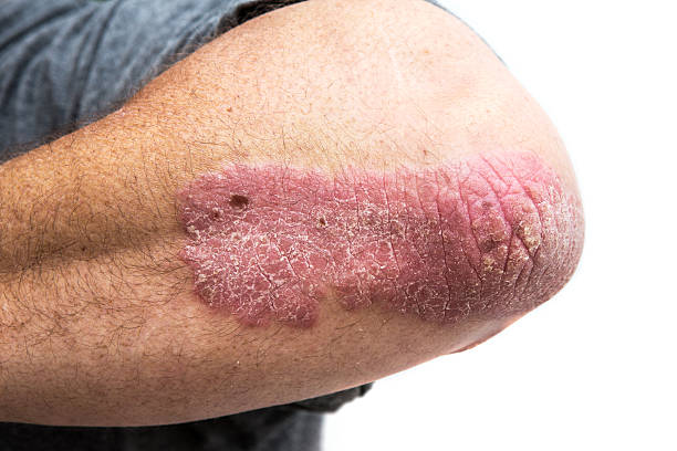 psoriasis on a mid age mans elbow psoriasis on a mid age mans elbow. Not isolated. photo psoriasis stock pictures, royalty-free photos & images