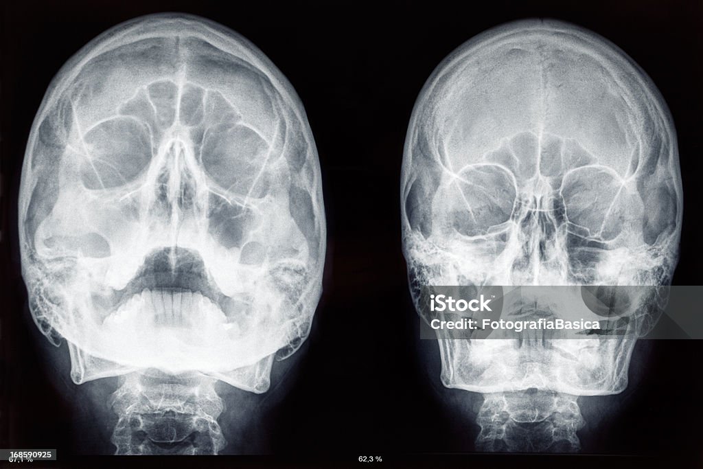 Dos cráneo rayos x - Foto de stock de Imagen de rayos X libre de derechos