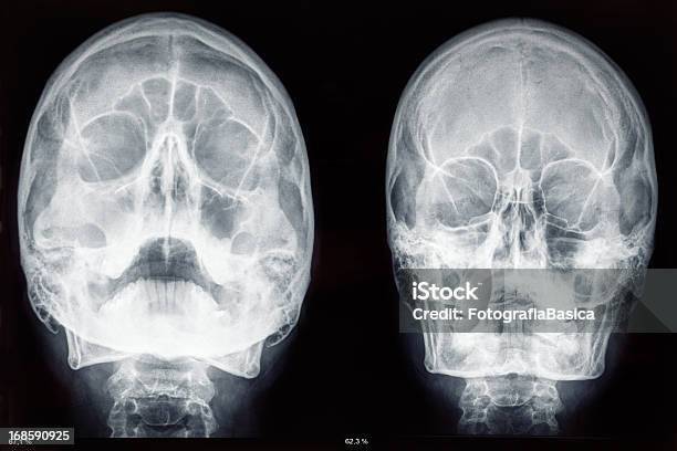 Dos Cráneo Rayos X Foto de stock y más banco de imágenes de Imagen de rayos X - Imagen de rayos X, Afección médica, Anatomía