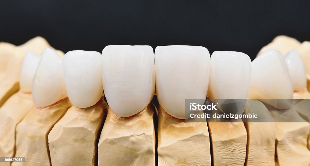 Folheados de Dentista - Royalty-free Dente de Engrenagem Foto de stock