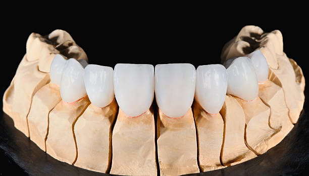 歯科 veneers - machine teeth 写真 ストックフォトと画像