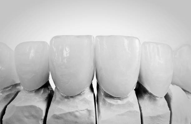 dental veneers - machine teeth fotos stock-fotos und bilder