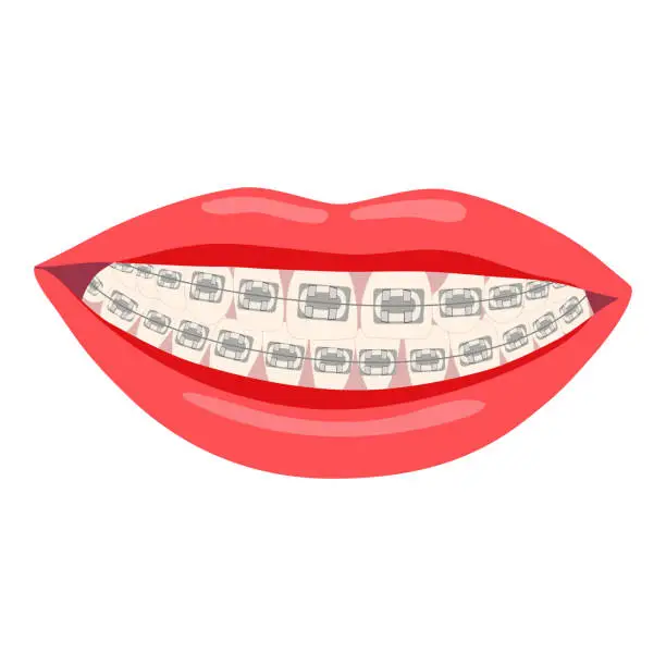 Vector illustration of Braces are dental tools that help correct problems with your teeth, like crowding, crooked teeth, or teeth that are out of alignment.