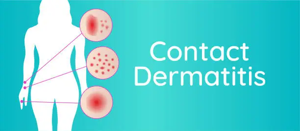 Vector illustration of Contact Dermatitis Background Illustration with Woman and Irritation Closeups