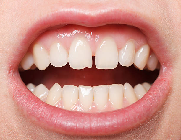 istock Diastema  between the upper incisors 168680281