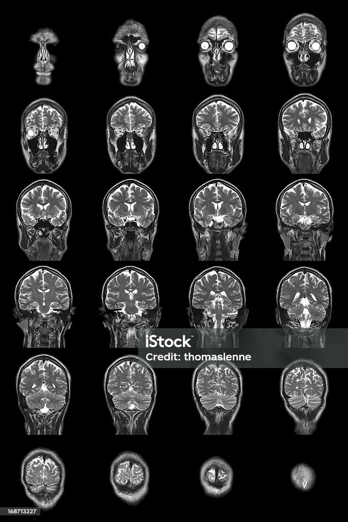 La mri del cerebro humano - Foto de stock de Cabeza humana libre de derechos