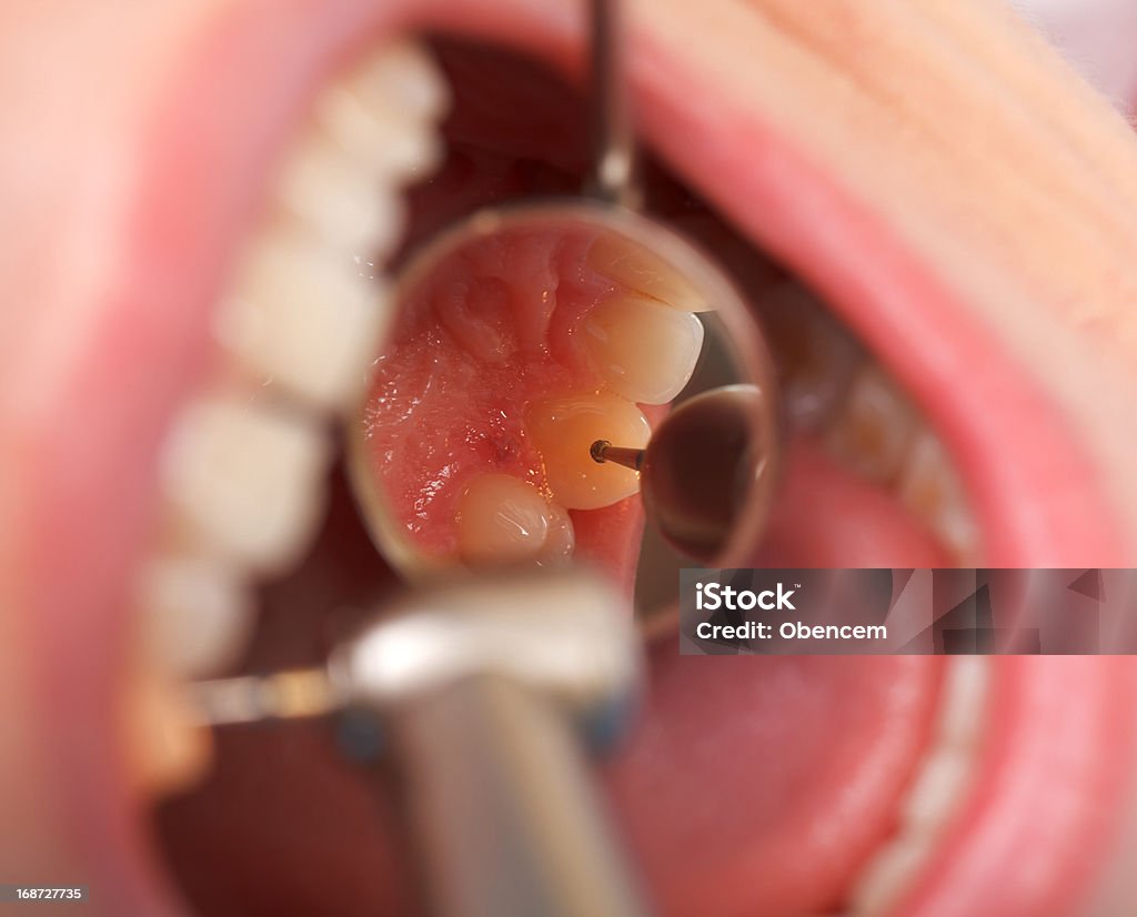 Perforación Dental - Foto de stock de Asistencia sanitaria y medicina libre de derechos