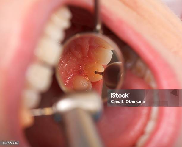 歯科掘削 - エナメルのストックフォトや画像を多数ご用意 - エナメル, クローズアップ, ヒトの口