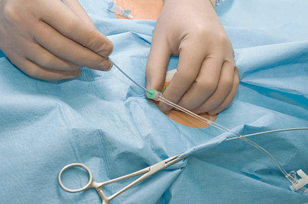 Cirurgião manipular um cateter flexível - fotografia de stock