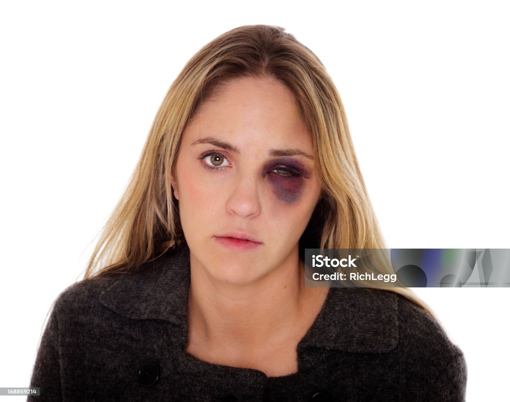 Donna con un occhio nero - Foto stock royalty-free di Donne