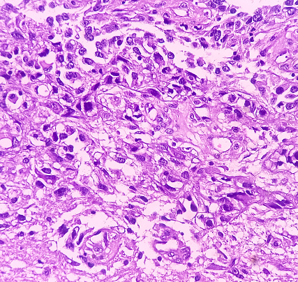 Kidney cancer: Microscopic image of metastatic clear cell carcinoma of kidney, the most common type of renal cell carcinoma. Show brain tissue of malignant neoplasm, large atypical bizarre cells.