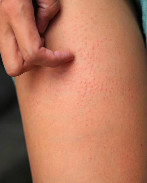 istock Allergic rash dermatitis eczema on skin. Hand scratching. 1689862745