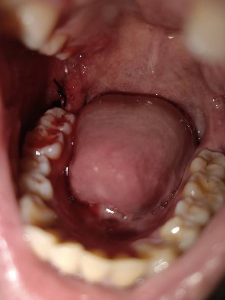 istock Stitching wounds for patients who have had their wisdom teeth removed. 1690081892
