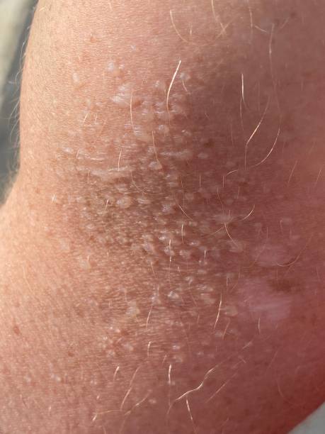 istock Sun damage to skin 1690717529