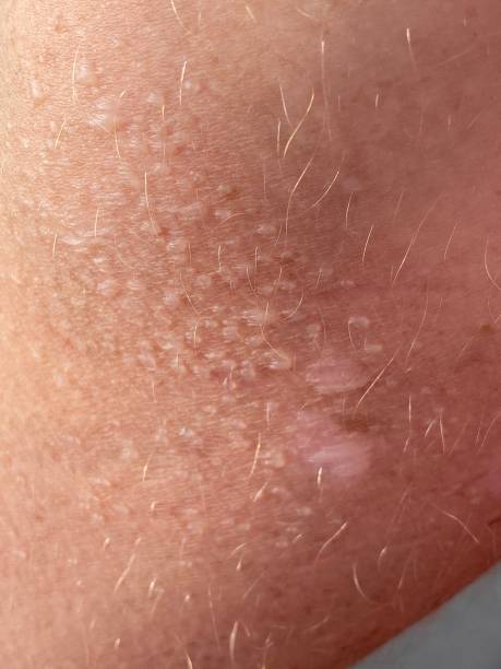 istock Sun damage to skin 1690717530