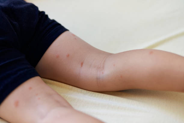 many of mosquito bites sore and scar on child legs, a boy scratching at lesion. - mosquito child bug bite scratching imagens e fotografias de stock