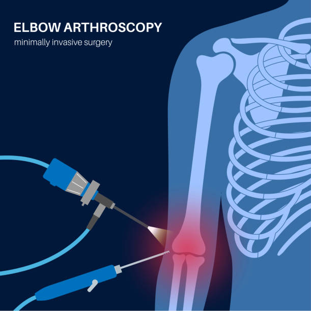Radius Injection 40+ Articular Injection Stock Illustrations, Royalty-Free Vector ...