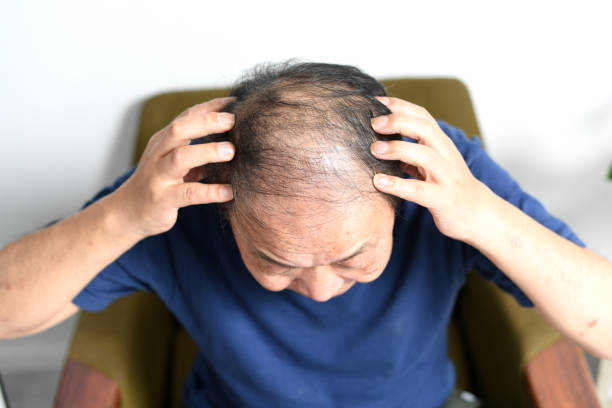 머리카락이 가늘어지는 아시아 노인의 머리 꼭대기 이미지 - 대머리를 감추다 뉴스 사진 이미지