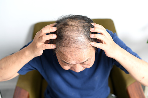 Image of the top of the head of an elderly Asian man with thinning hair