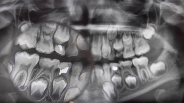 en regardant panoramic dental x-ray image through magnifying glass pov - 3517 photos et images de collection