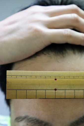Close-up of thin-haired man measuring forehead length