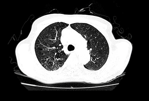 폐색전증 폐암 및 Covid19 진단을 위한 흉부 축 보기의 Ct 스캔 단층 촬영에 대한 스톡 사진 및 기타 이미지 - 단층 ...