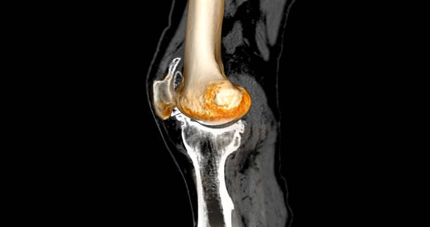 CT Knee or CT Scan image of knee joint sagittal view with 3D . stock photo