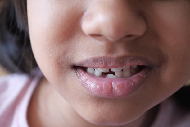 istock detail shot of child with teeth missing 1694123008