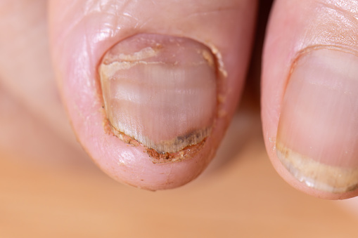 La quimioterapia contra el cáncer causa uñas quebradizas o escamosas. photo